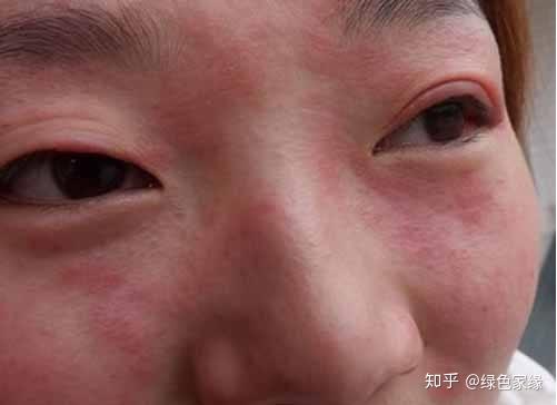 甲醛过敏怎么治疗?