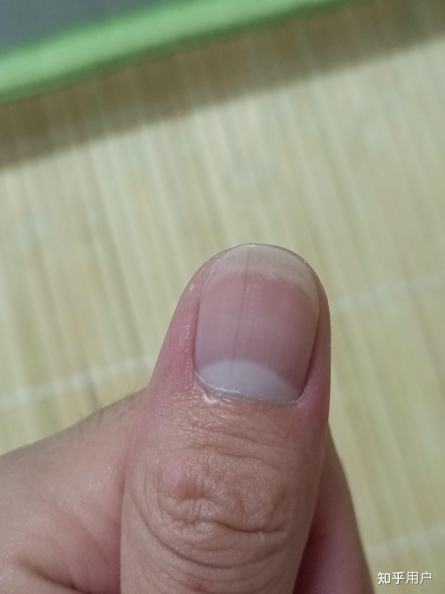 指甲里面有一更线是怎么回事?