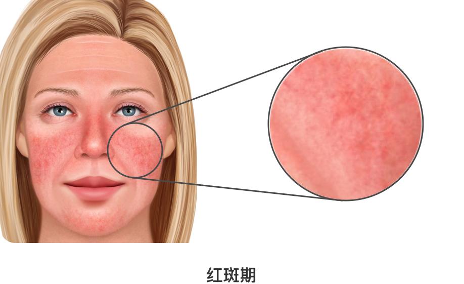 玫瑰痤疮是什么?有哪几个阶段?每个患者都会发展到最严重的阶段吗?