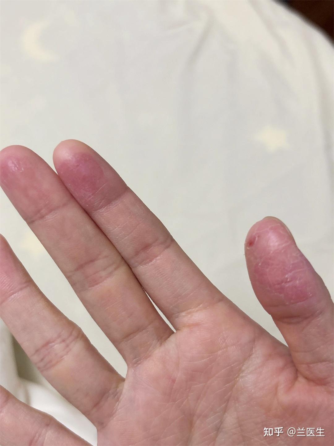 冬天怎么有效缓解手裂严重的症状? - 知乎