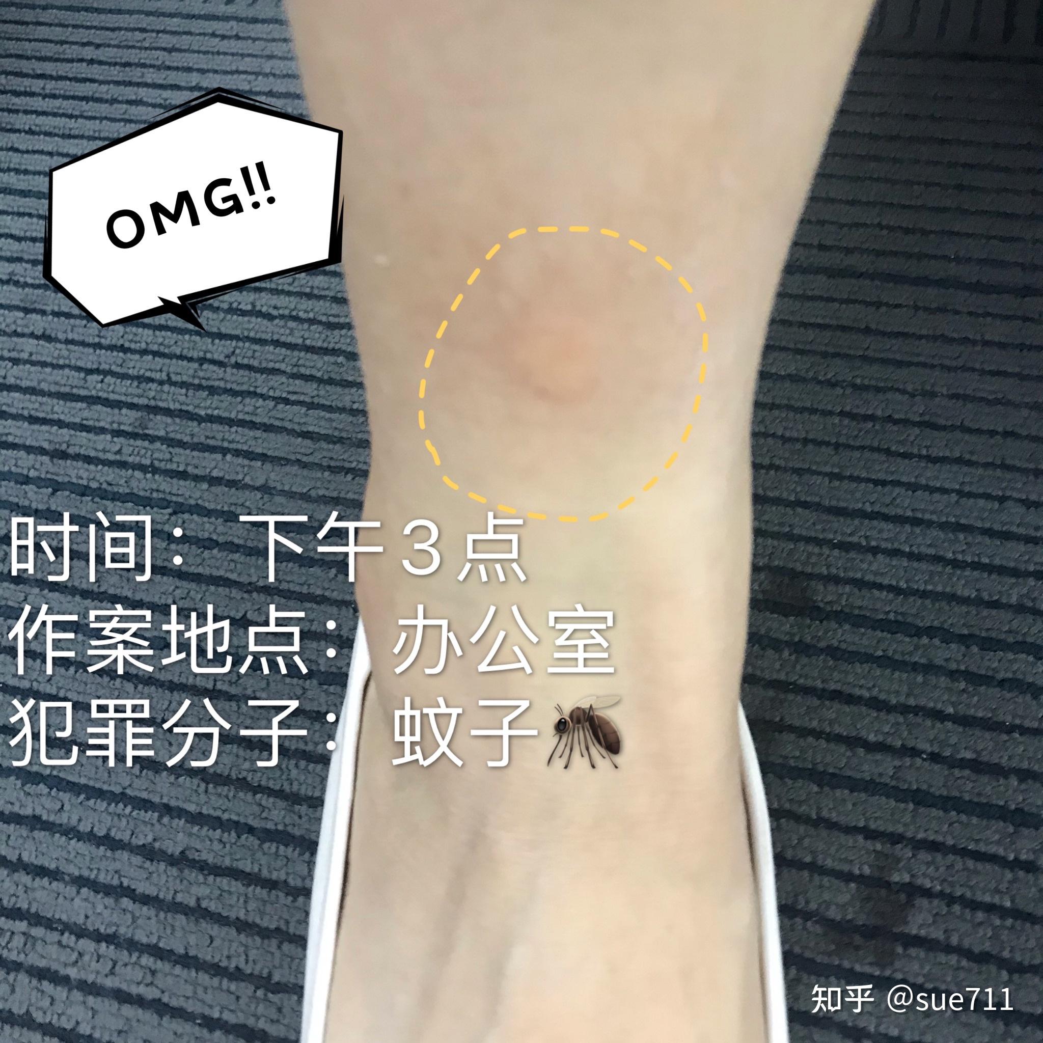 大家有被蚊子叮包后的奇葩照片吗