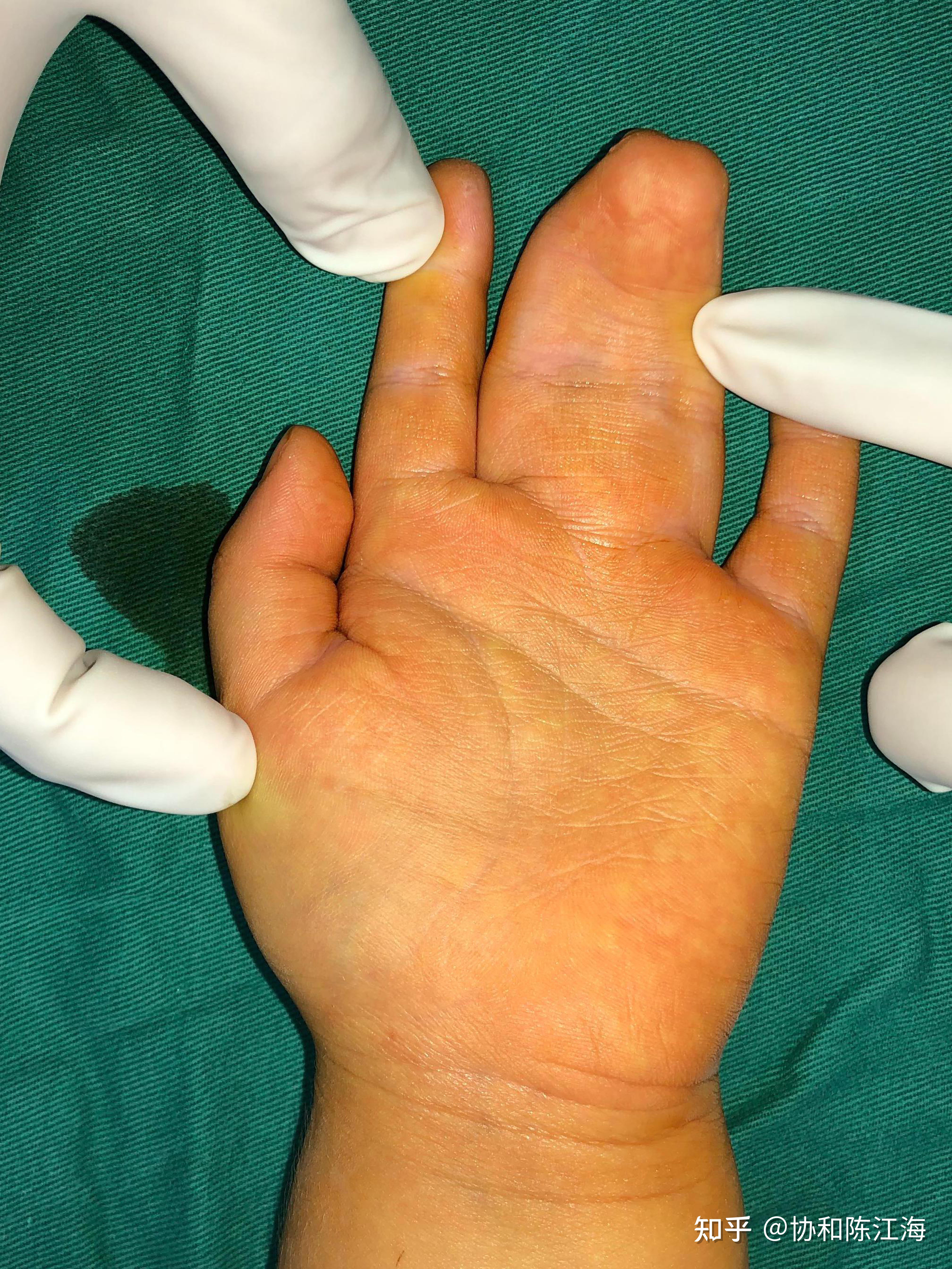 现在的医学技术可以将严重并指手指畸形手术成常人吗?