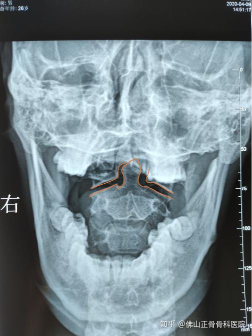 额头头痛一整天原来是寰枢椎小关节紊乱67保守手法椎体复位改善头痛