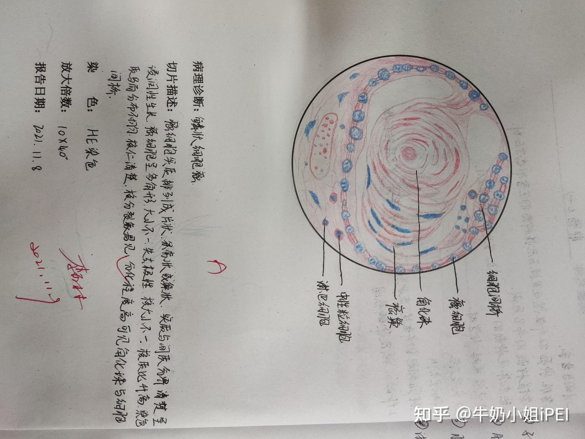 鳞状细胞癌3结核性肉芽肿2肉芽组织1肾浊肿