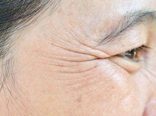 鱼尾纹注射除皱针,为什么眼纹反而增加了?