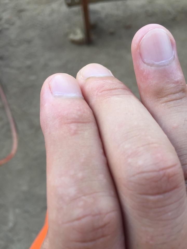 手上突然长了好多小水泡,不痛也不痒,除了手背其他地方都有,不过密集