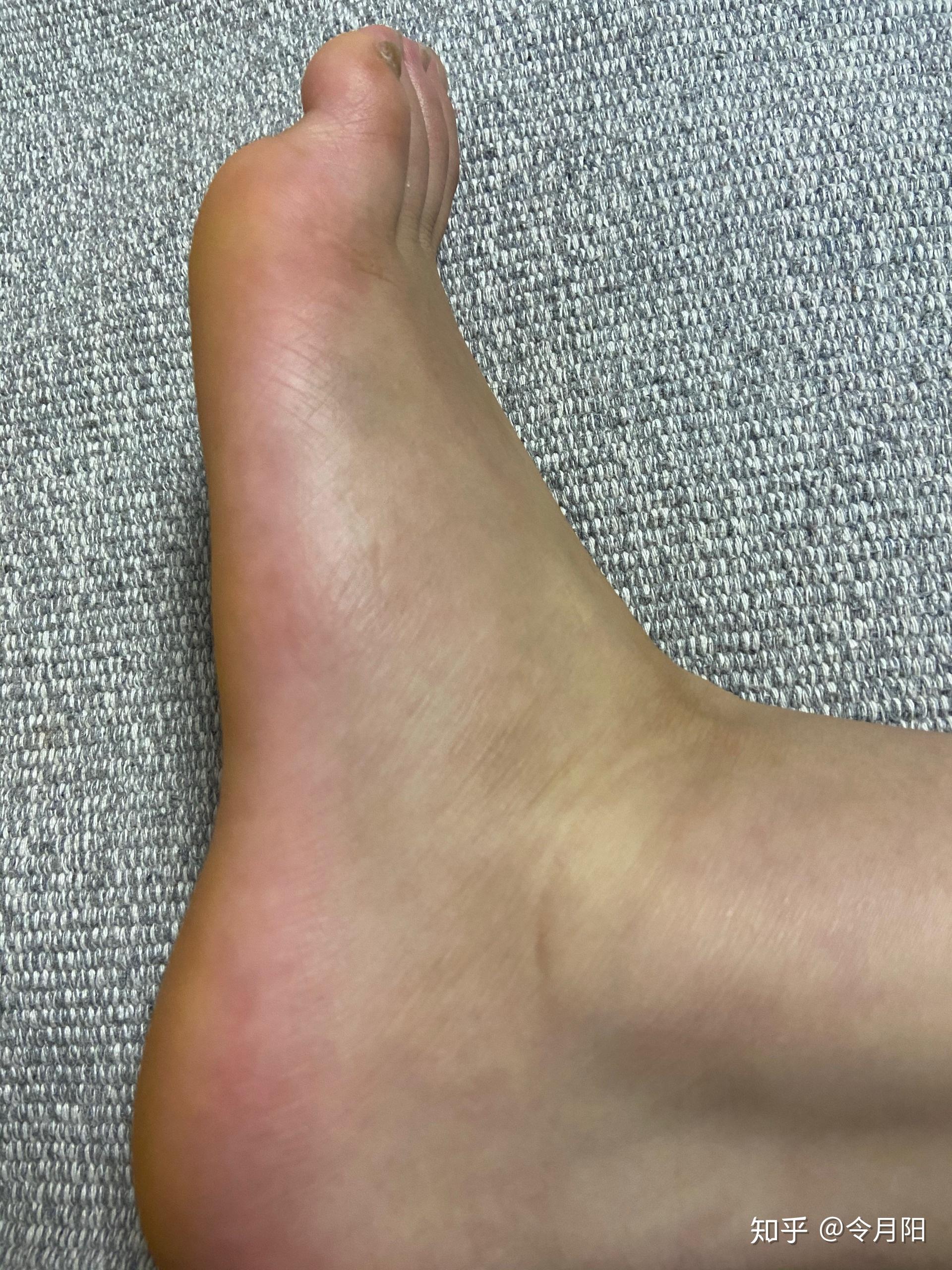 扭伤后脚背有肿块,请问怎么消肿? - 知乎