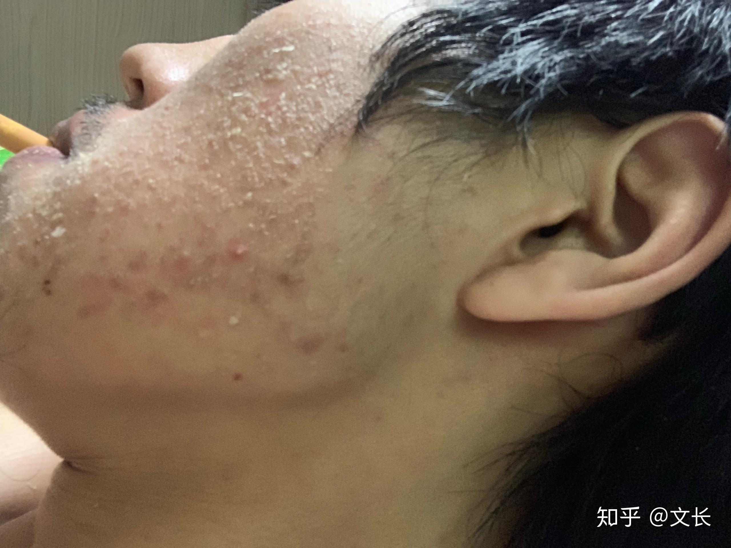 使用阿达帕林后,皮肤非常干燥脱皮,灼烧疼痛,而且脸特别红? - 知乎