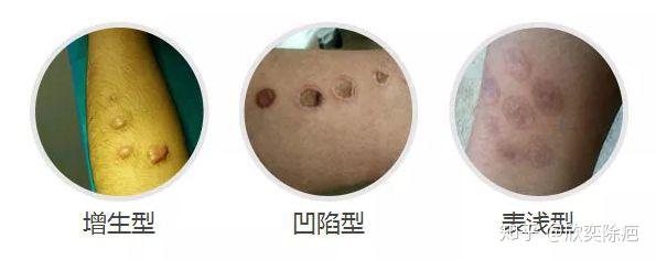 另类刺青烟疤如何祛除