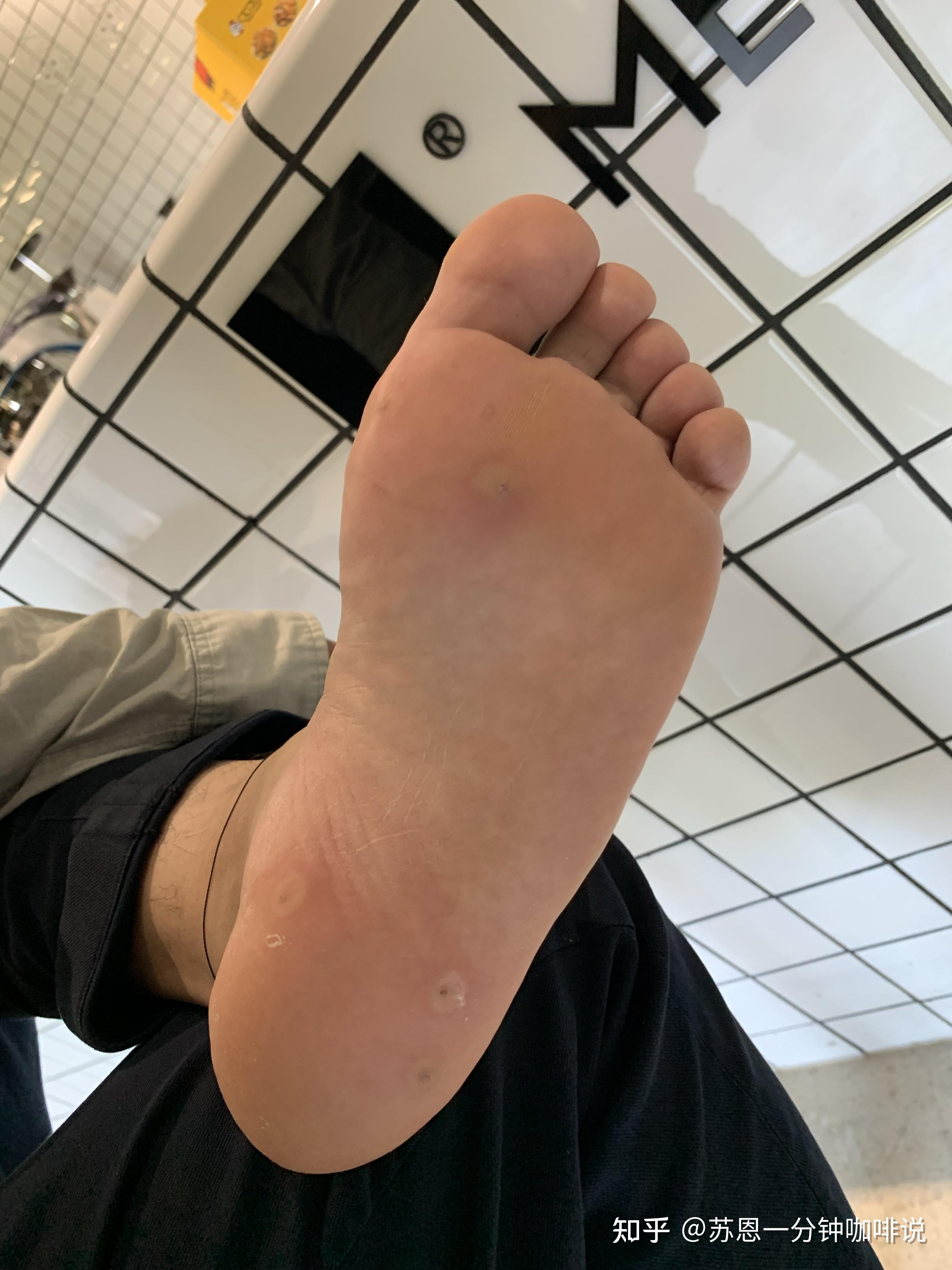 液氮冷冻治疗后手指上出了血泡而且越来越大该怎么办? - 知乎