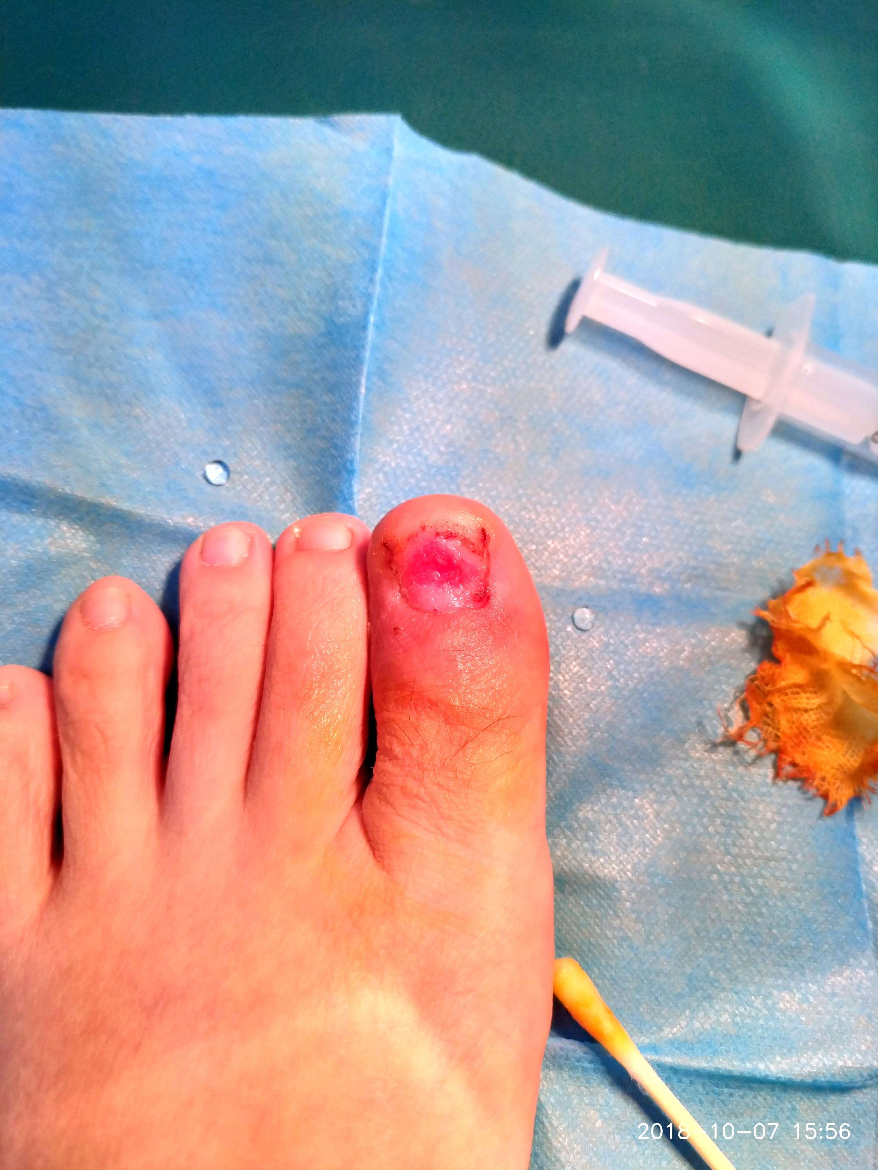 甲沟炎拔甲是怎样的体验? - 知乎