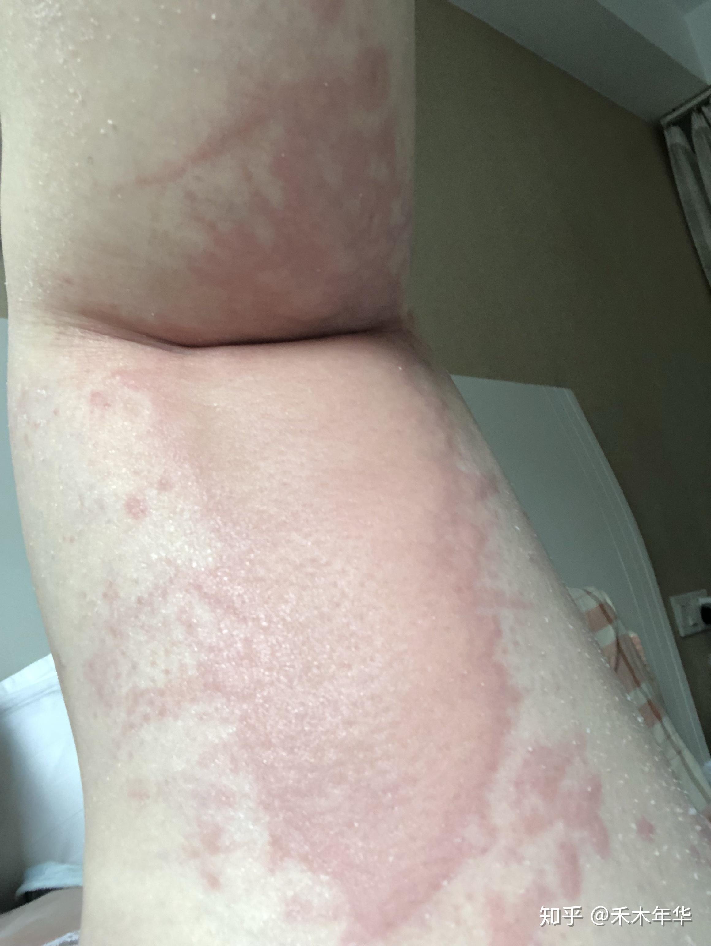有没有小伙伴和我一样的荨麻疹症状上图
