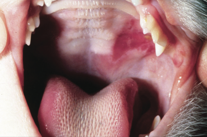 口腔上颚溃疡怎么治疗图片