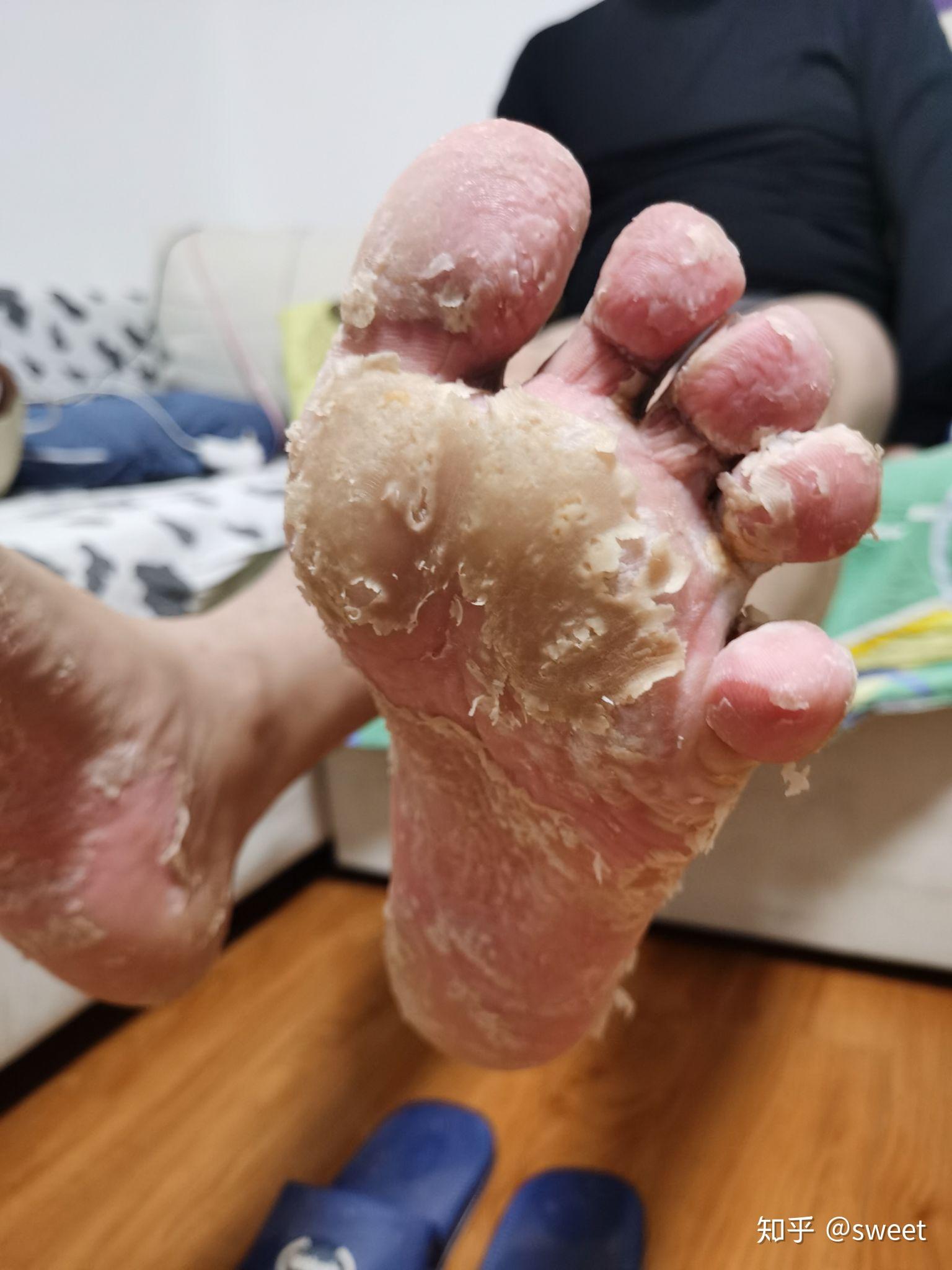 「足癣」是一种什么疾病?如何预防和治疗? - 知乎