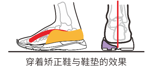 小孩子扁平足是什么样子 v2-2a61b1471986655befe1599706fd961a_1440w.jpg?source=172ae18b