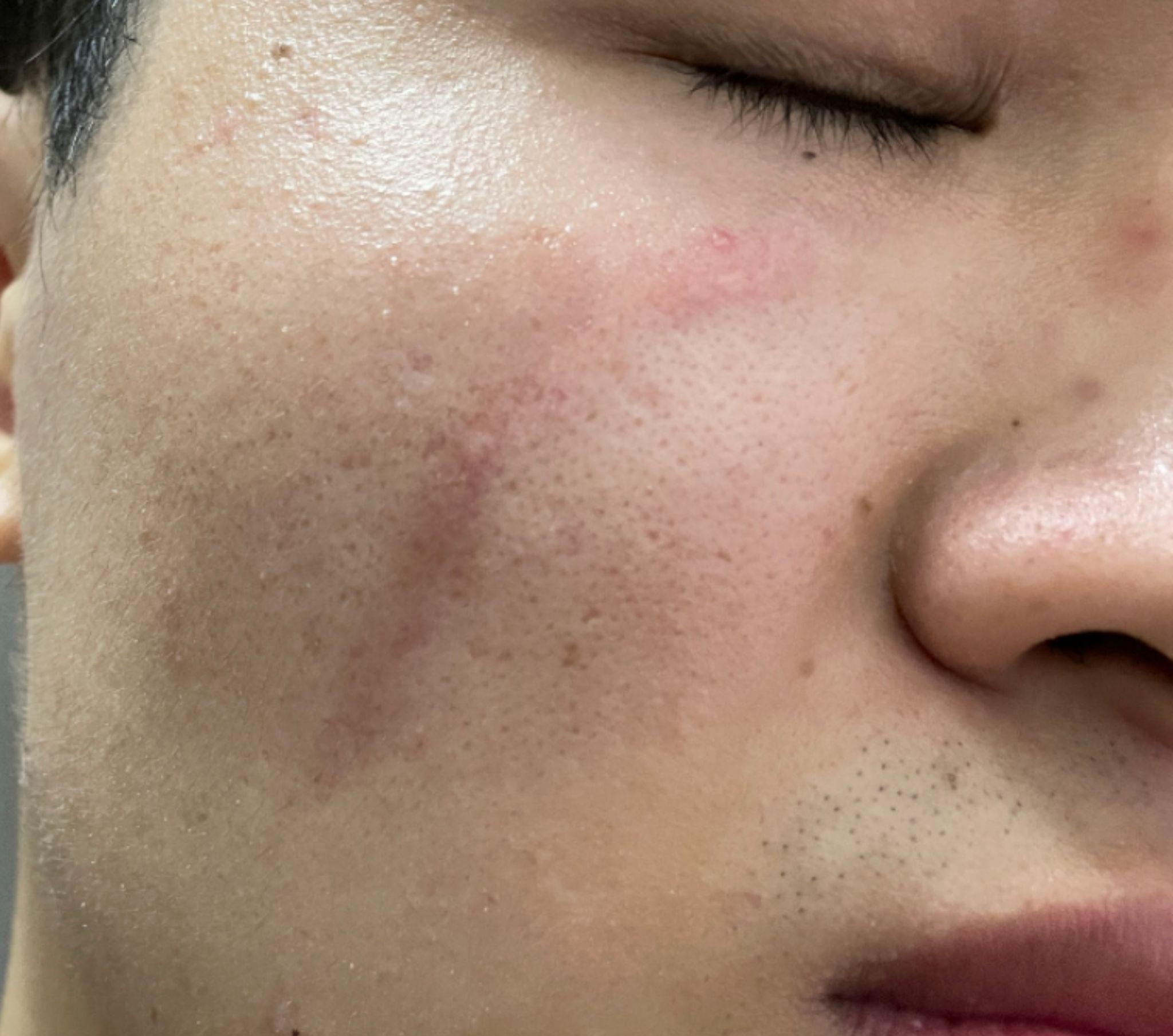 怎么样才能去掉脸上的凹陷型疤痕啊,广告不要来好不好 ,目前也没有钱