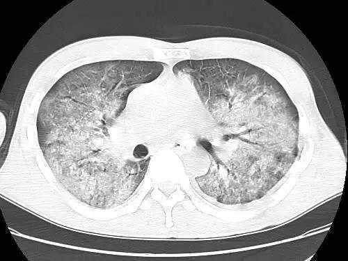 新冠病毒感染引起白肺是什么?