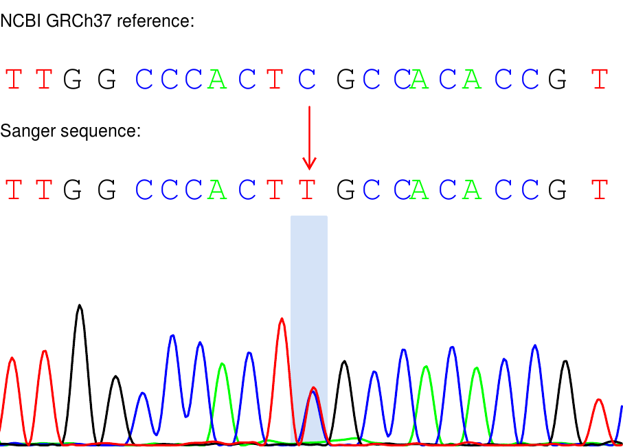案例分享罕见病基因诊断先天性去糖基化障碍ngly1‐cddg