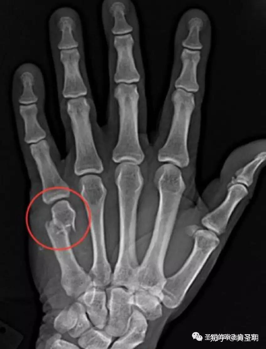 拳击运动腕关节的损伤及康复 知乎