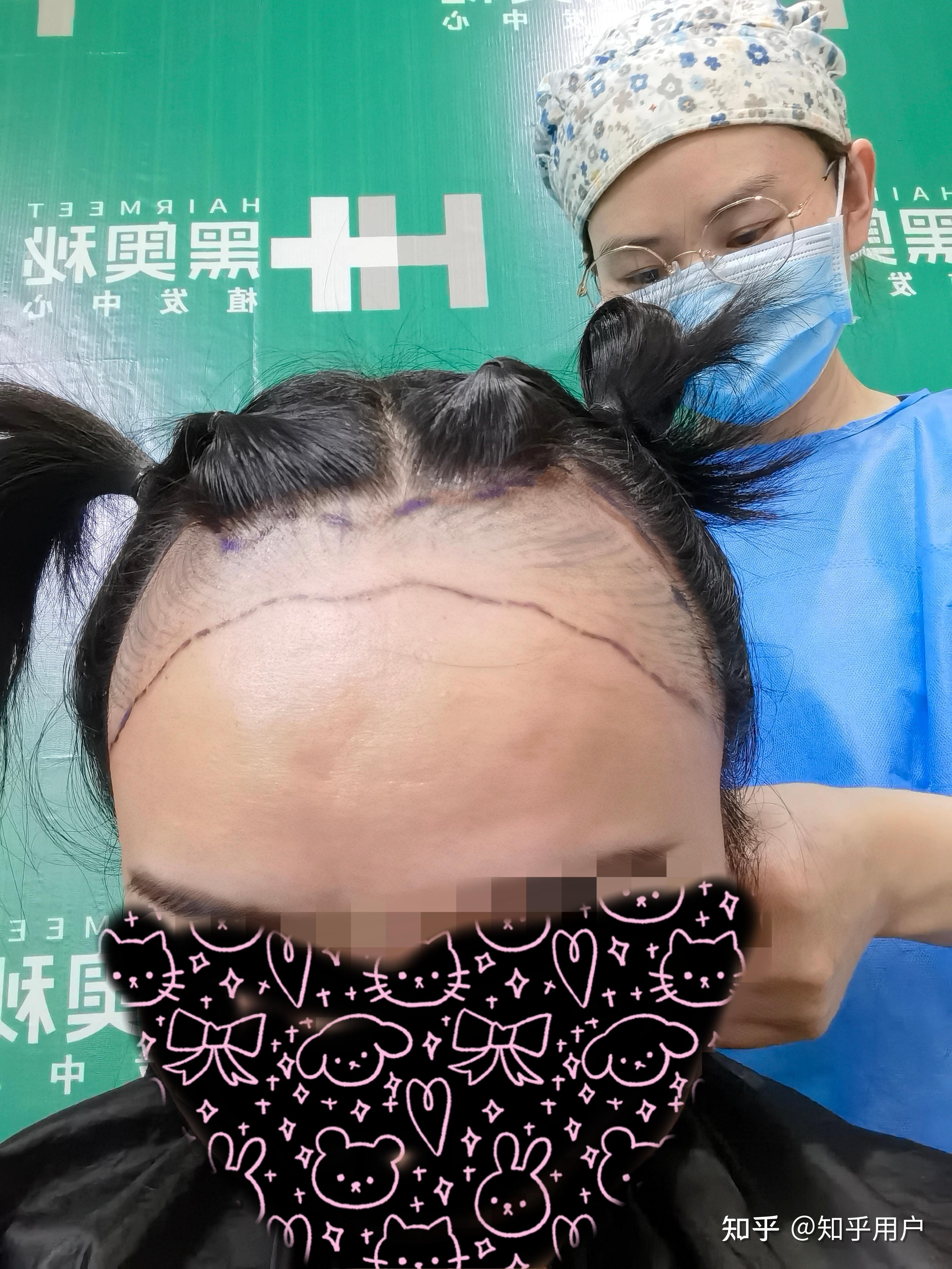 女生秃顶的植发(头发种植 秃顶 女人)