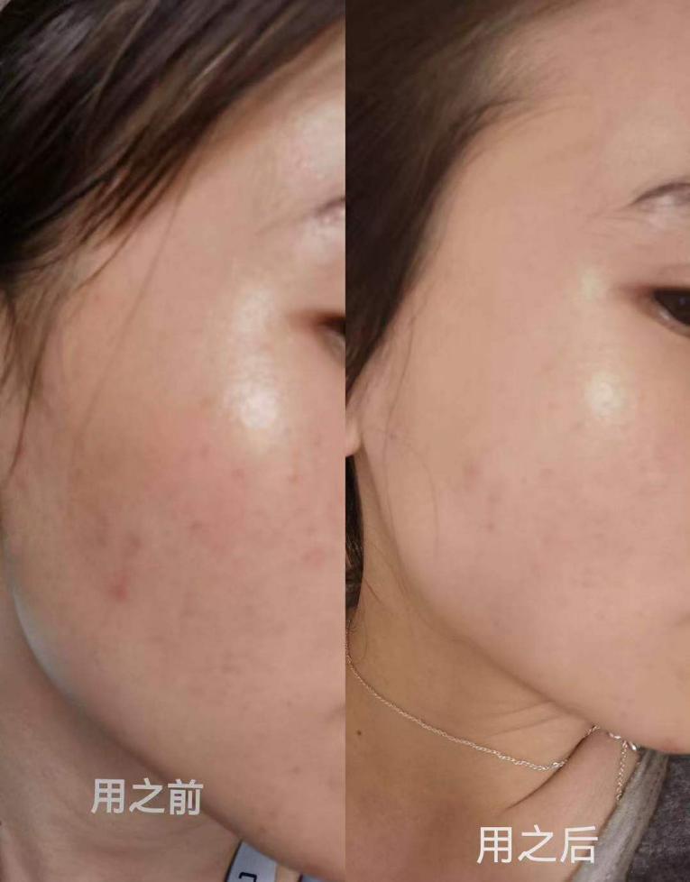 你们闭口粉刺都是怎么怎么解决的?