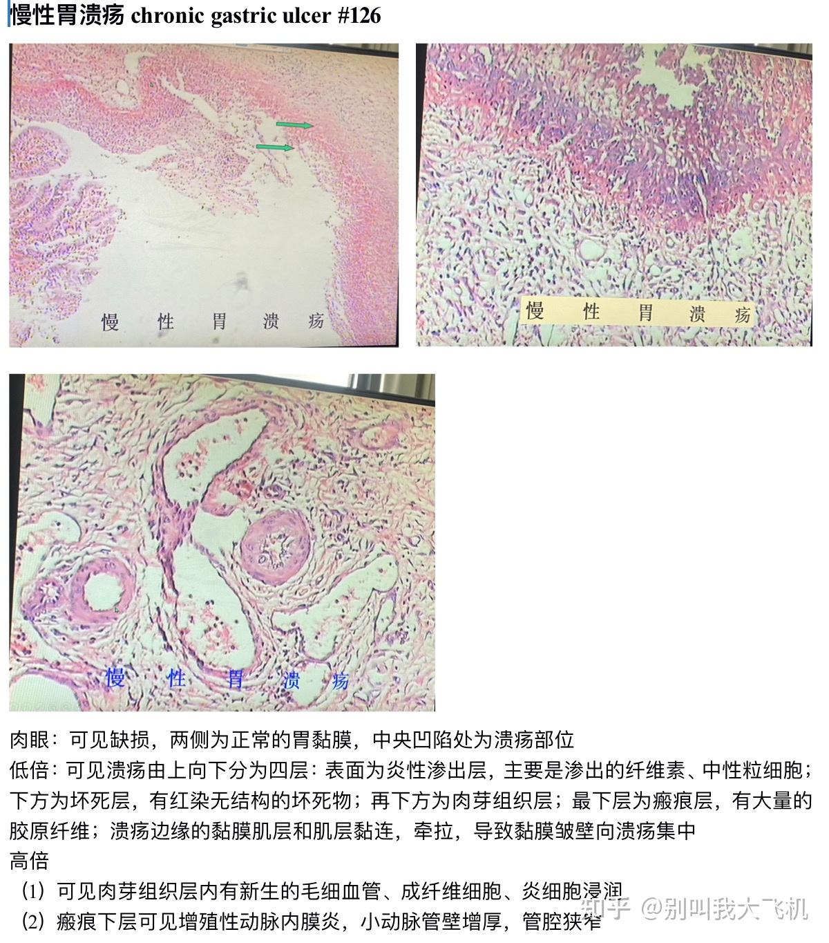 胃溃疡镜下手绘图图片