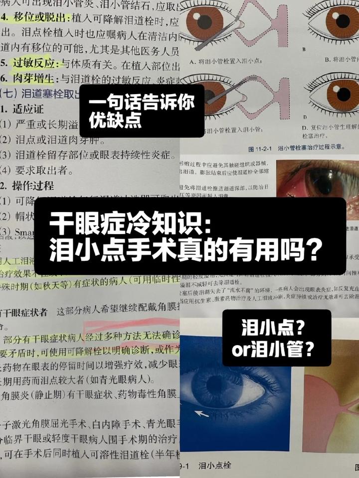 干眼症｜泪小点手术你不知道的③件事 - 知乎