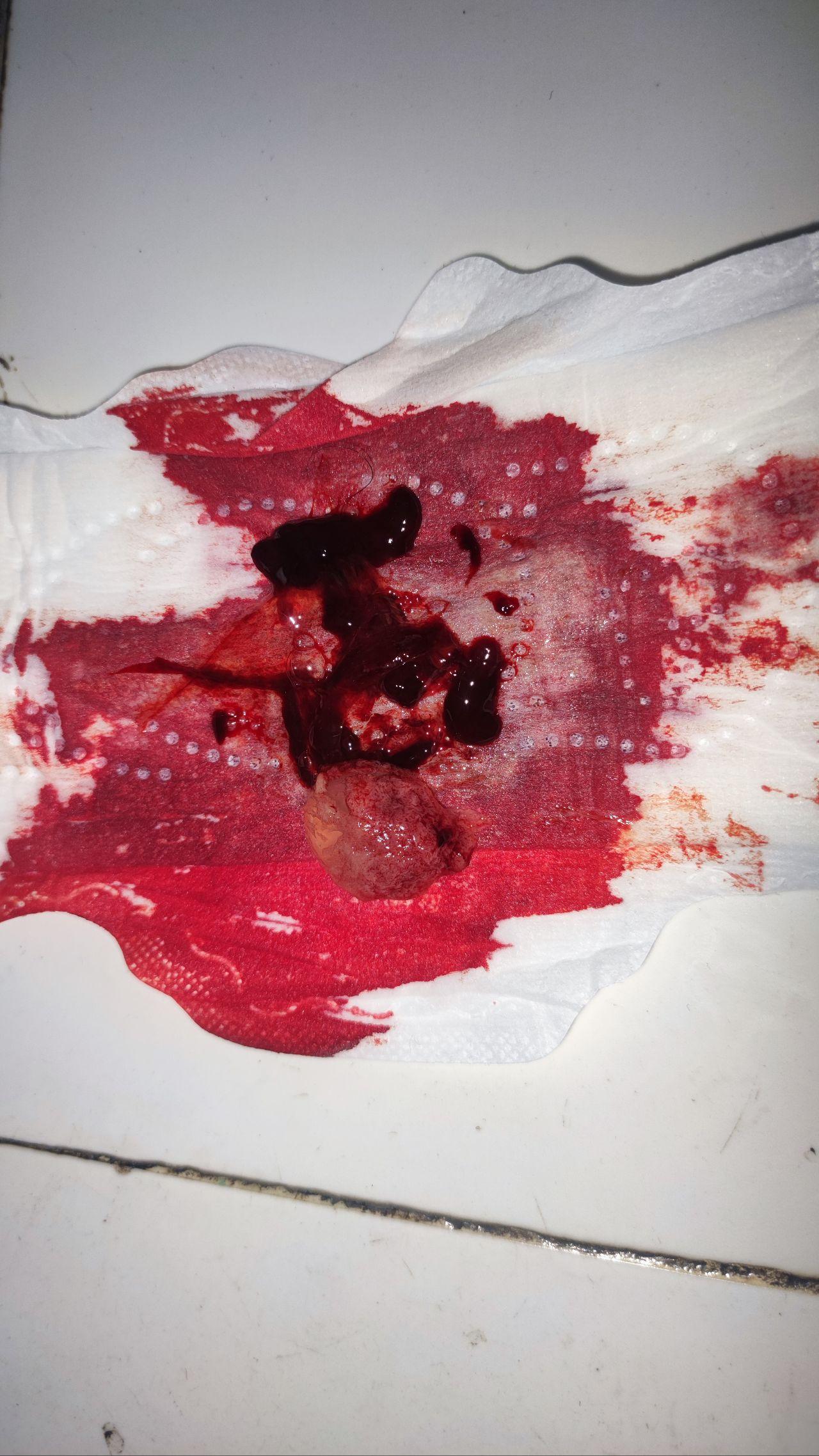 两次剖腹产后❌药流进行中
