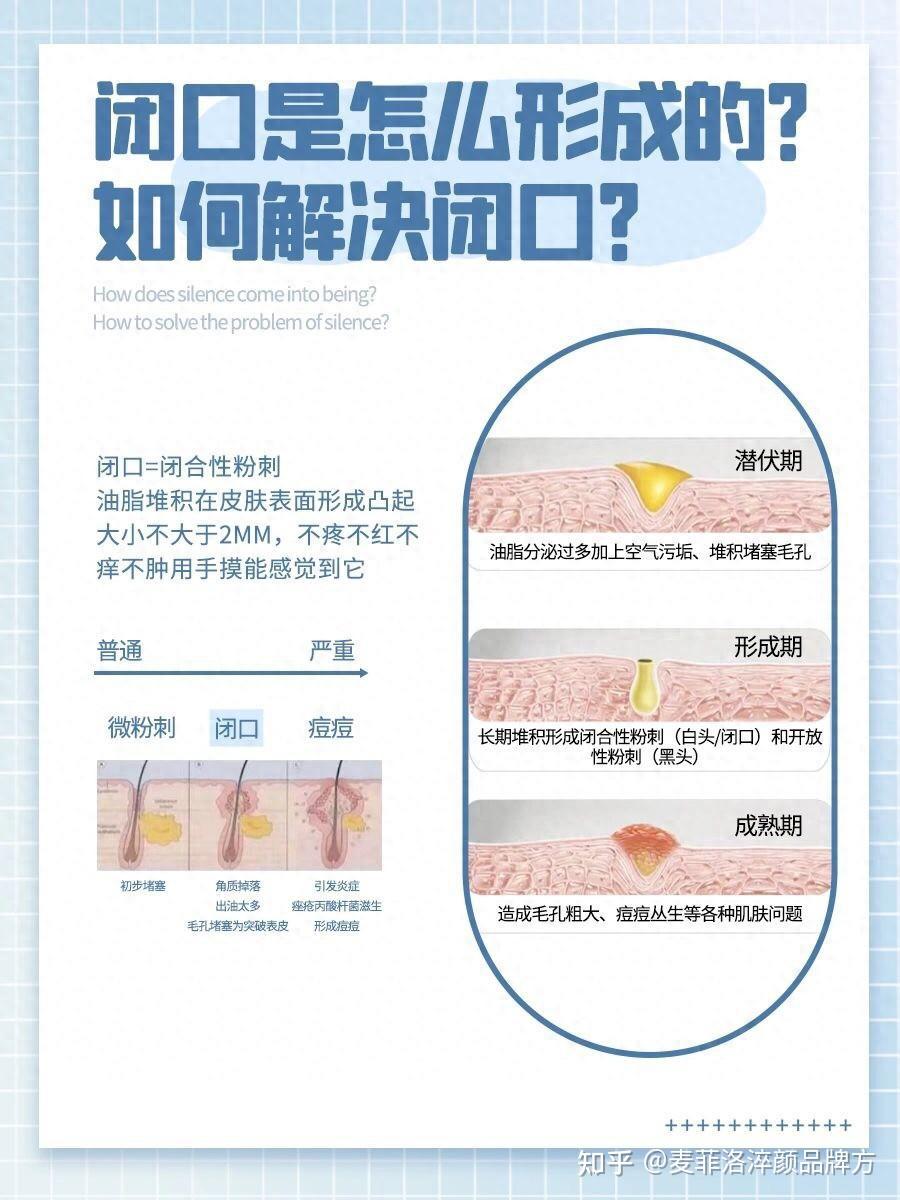 1分钟了解闭口是怎么形成的?如何解决闭口 - 知乎