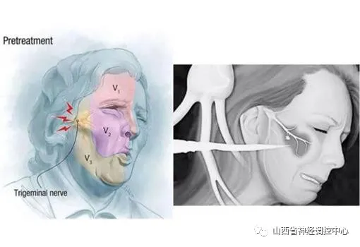 故事】微球囊壓迫手術治療三叉神經痛,用小小一顆