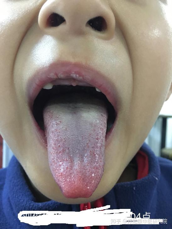 肚子里咕噜噜有水声的舌象