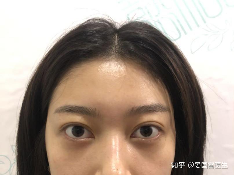 眼睛戴眼镜变形之后可以做埋线吗? - 知乎