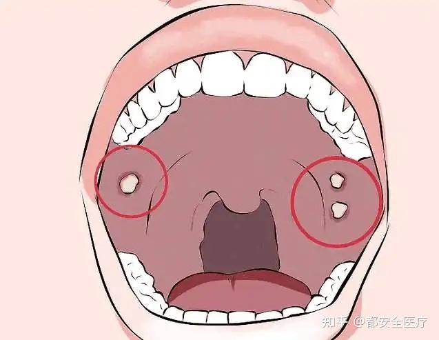 36岁歌手因口腔癌去世!「咬」、口咽癌、hpV三者间有什么关系? - 知乎