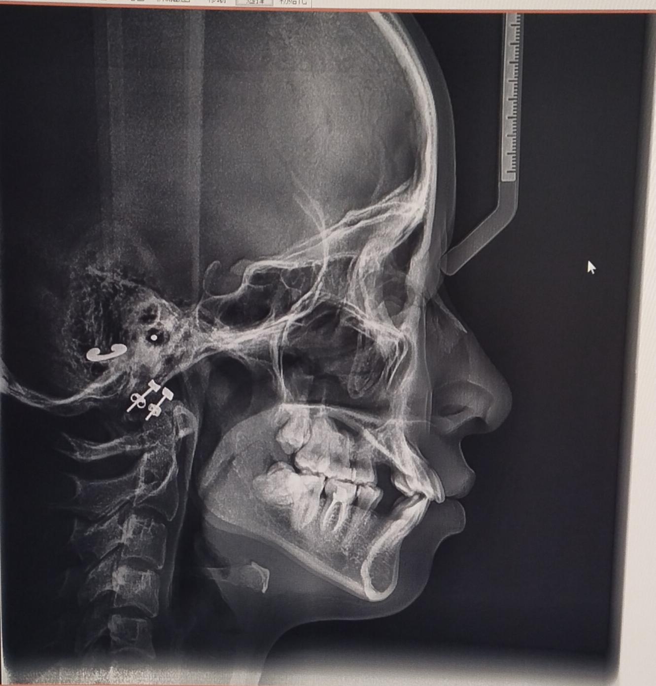 头颅侧位片怎么看能看看我的吗