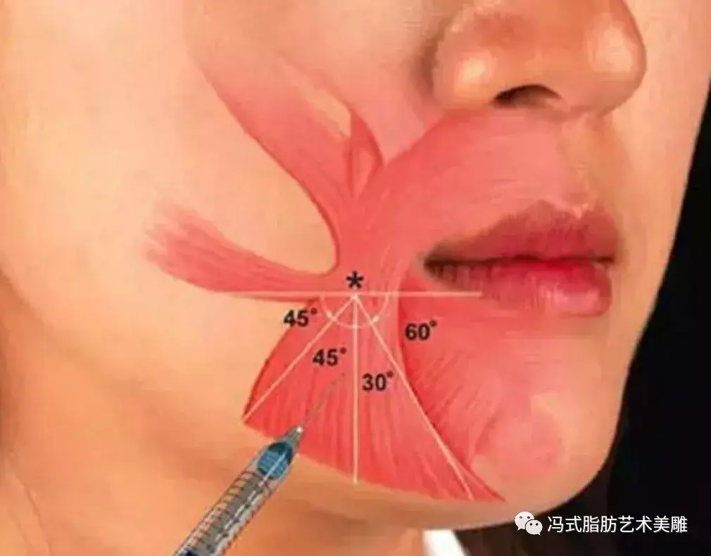 除了手術打針法令紋真的不可去除嗎