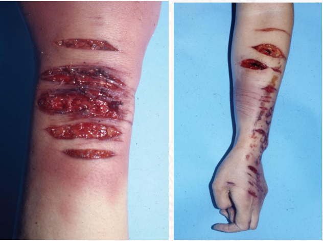 机械性损伤之锐器伤,讲讲自伤的刀法差异 - 知乎