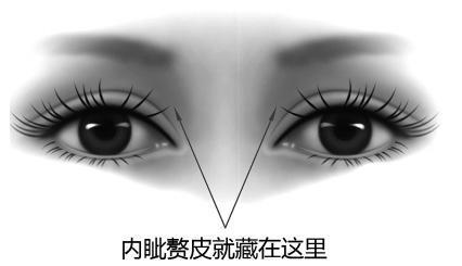 我这样的眼睛需要开眼角吗?怎么看内眦坠皮?