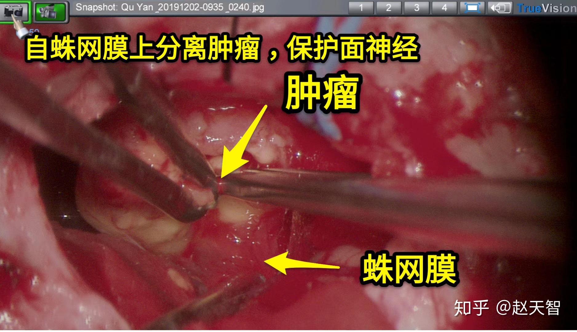 【病例分享】听神经瘤微创手术(蛛网膜外切除肿瘤,完美保留面神经功能