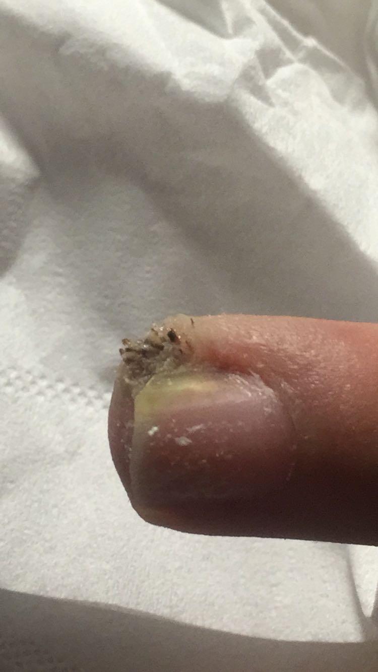 请问我的手指怎么啦,我的天,是甲周疣吗,如果不去手术会扩散到整个