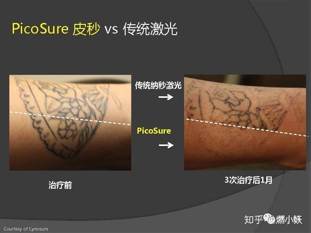 在说到如何鉴别真假皮秒之前,我必须要吐糟说下目前市场的情况.