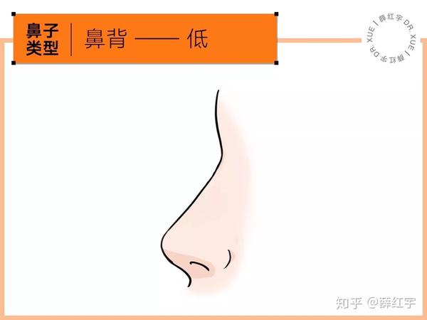 低鼻、宽鼻、驼峰鼻、鼻中隔偏曲……你是哪种鼻子?应该如何改善? - 知乎