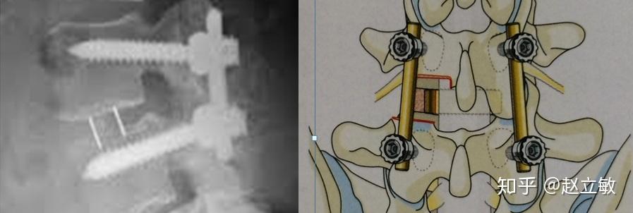 骨及融合器固定好椎弓根螺钉及钉棒有的医生会先植入钉棒系统预紧固定