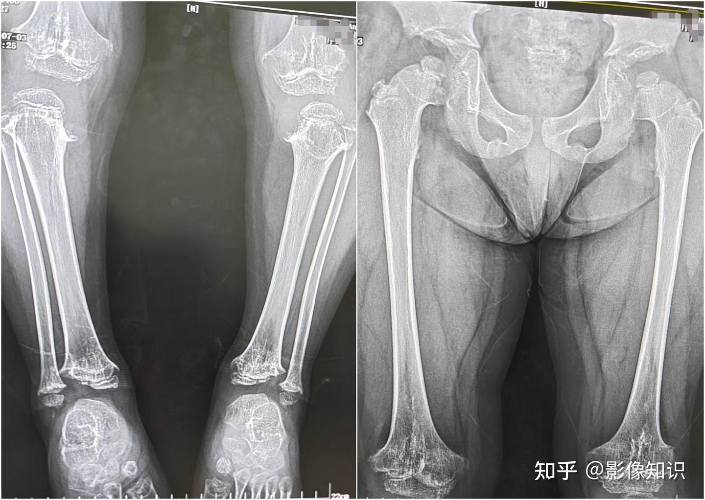 典型病例（骨骺，干骺端发育异常（假性软骨发育不全）） - 知乎