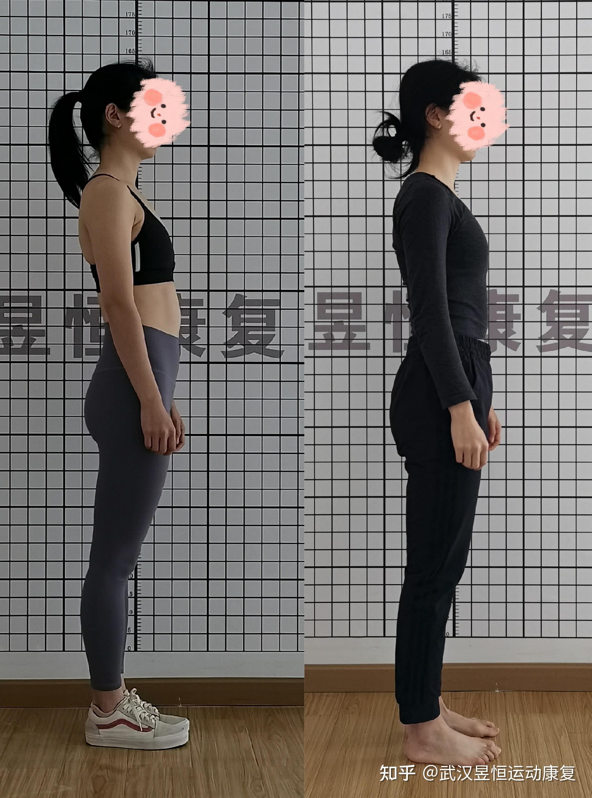 上班越久，体态越丑？快来拯救你的探颈、圆肩驼背、高低肩-美容项目-leyu·乐鱼体育(中国)官方网站-登录入口