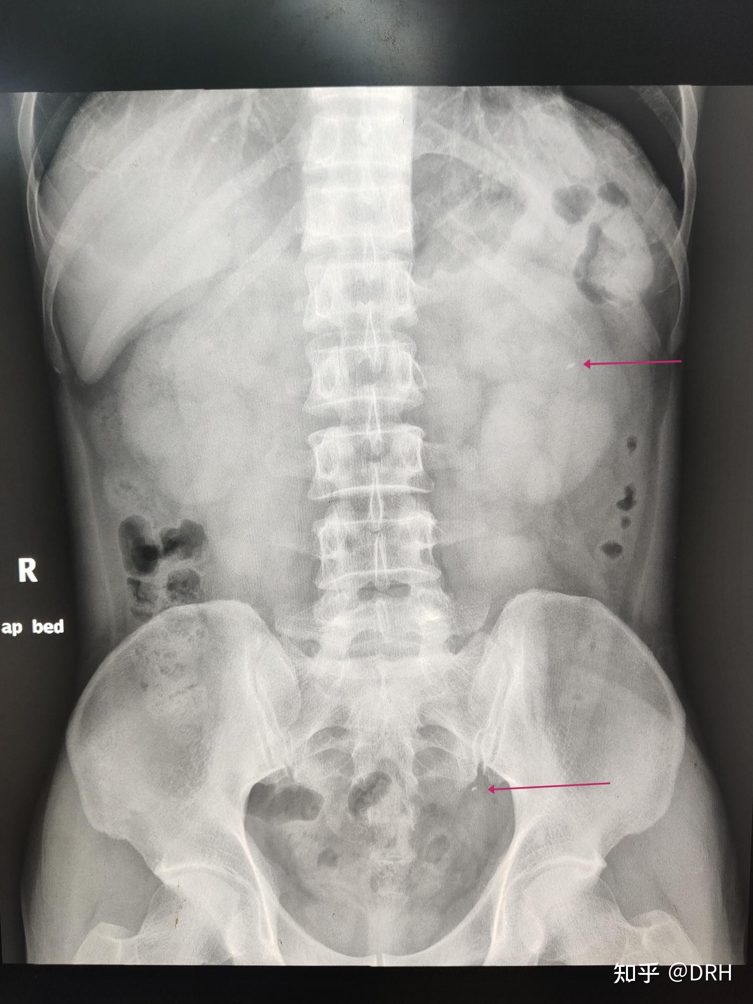 关于腹部正位片