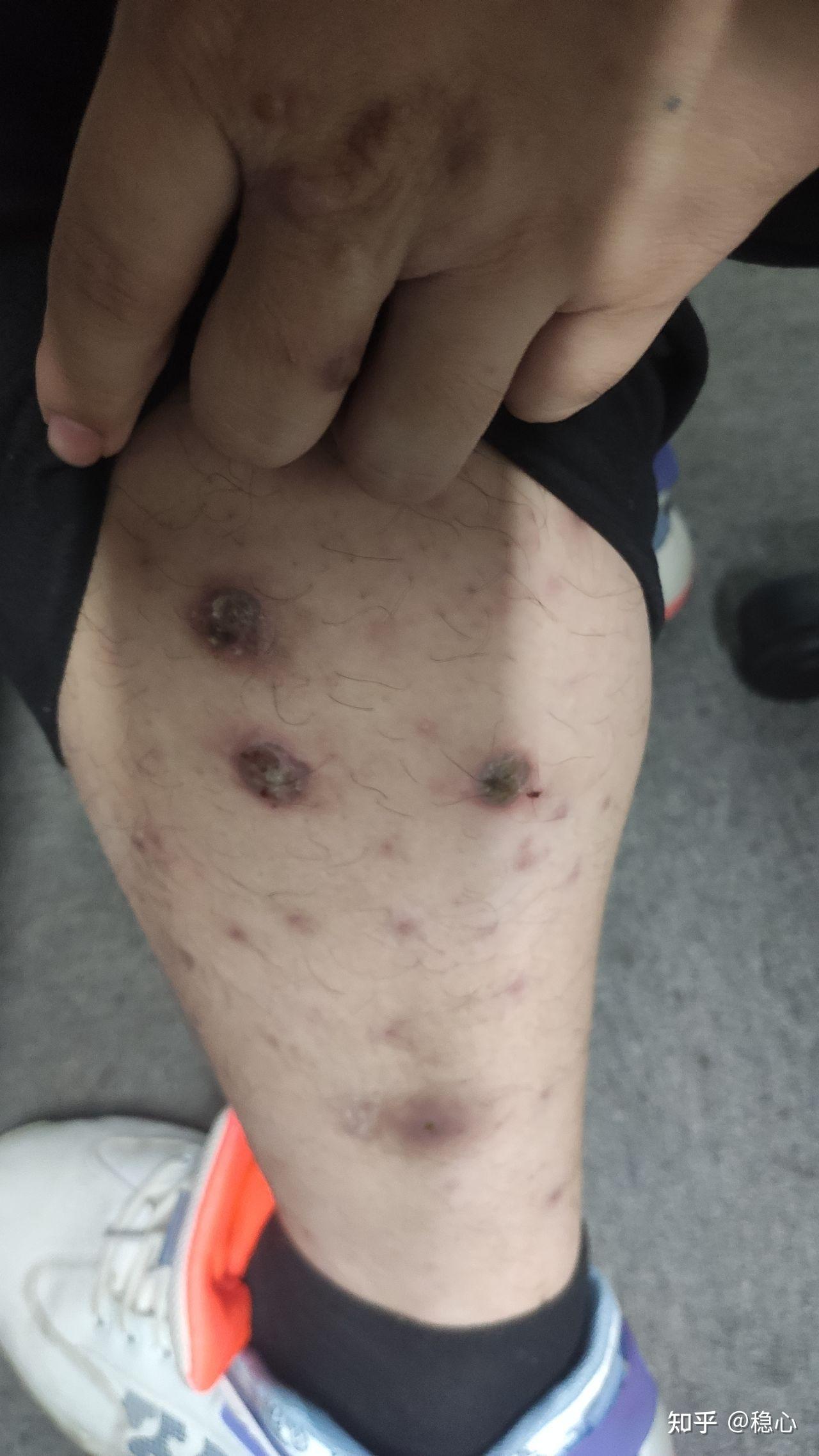 液氮治疗过程记录——结节性痒疹治疗