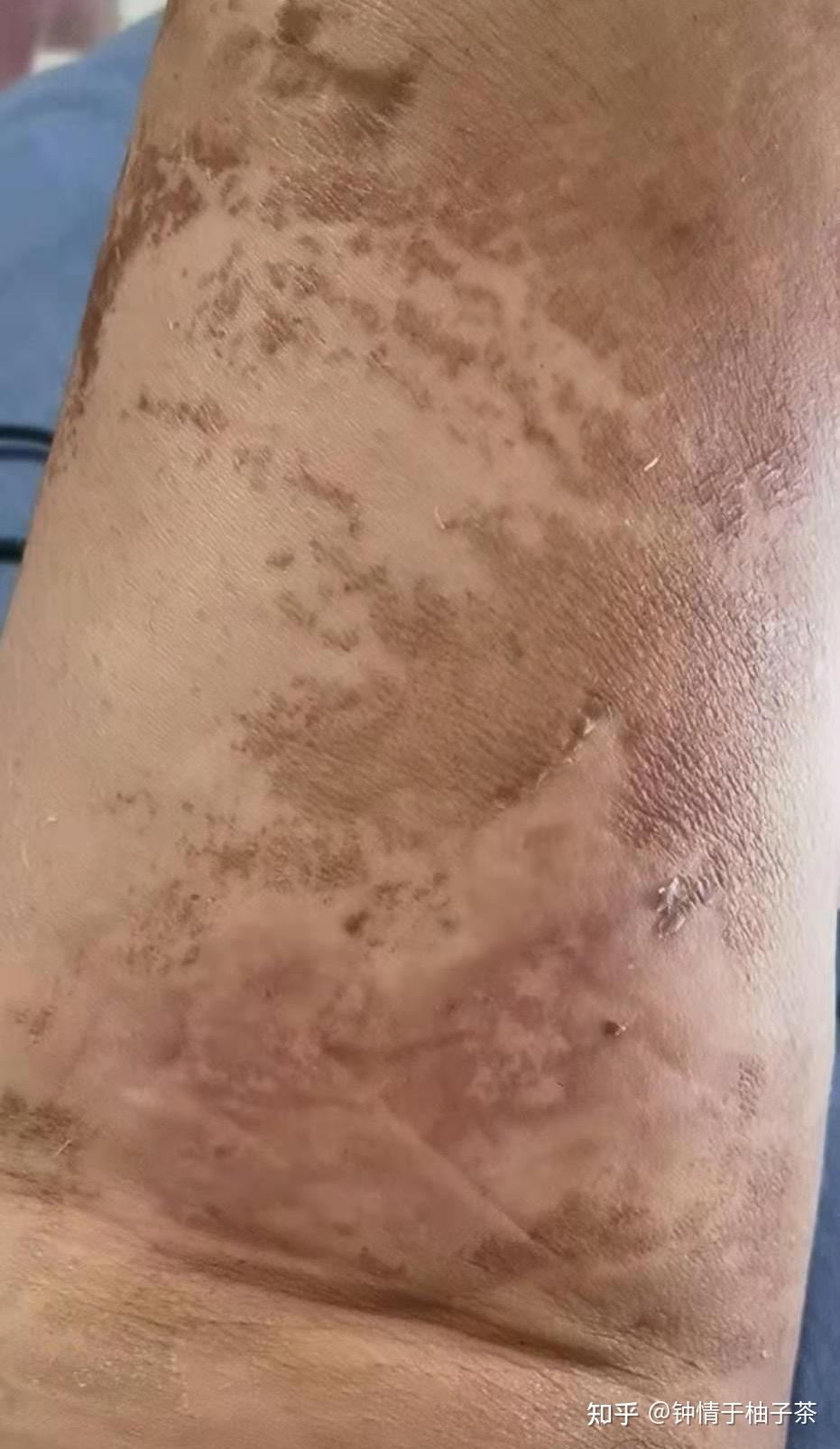 大腿抽脂够鸡皮疙瘩(大腿抽脂后腿里面有小疙瘩)