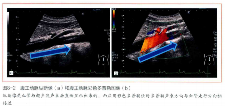 腹主动脉纵切面,超声下如何显示?都要观察哪些细节和要点? - 知乎