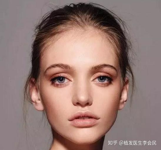 发际线高的问题有好的办法解决吗