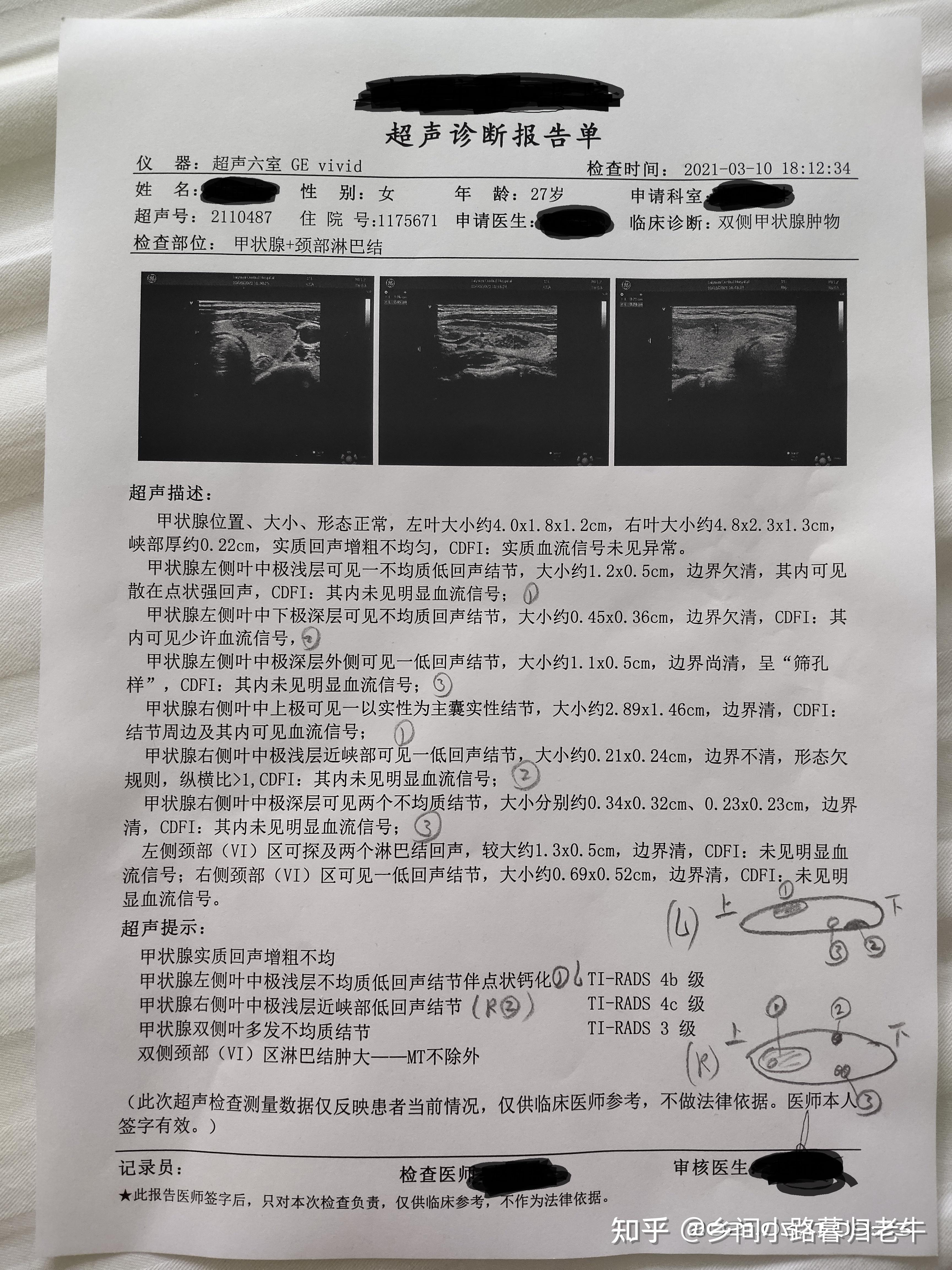 分享我的甲状腺癌从发现到手术全过程
